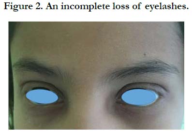Trichotillomania of Eyelashes: An Uncommon Disorder